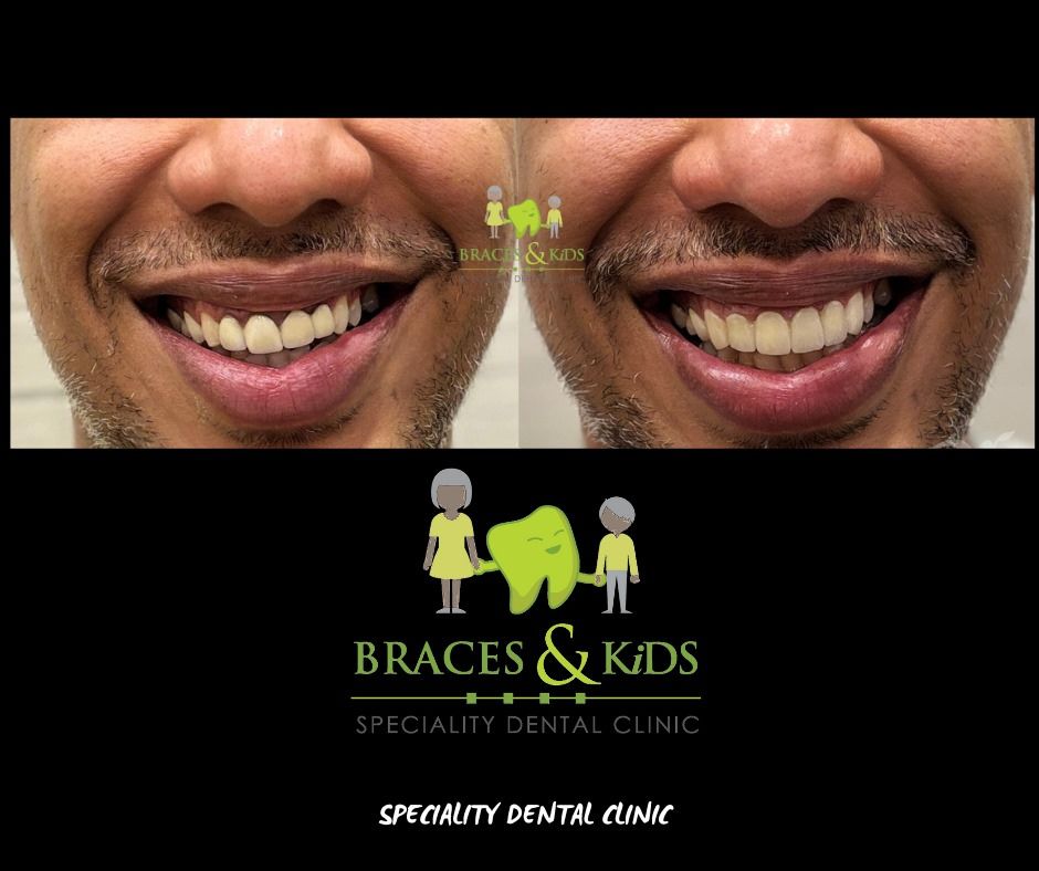 transparent aligners"