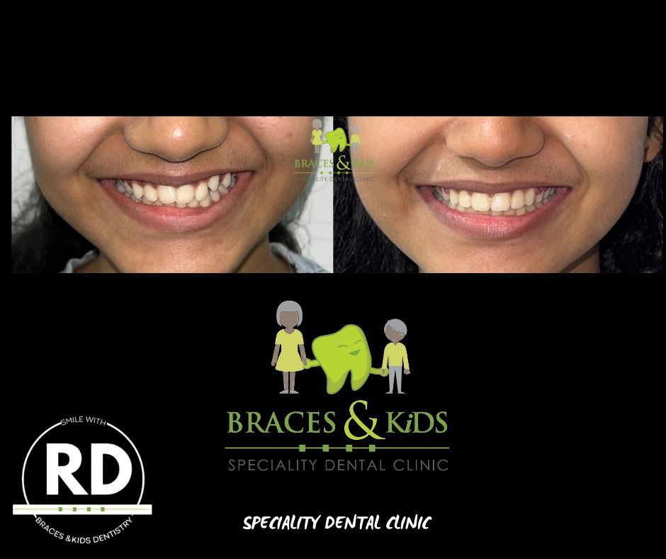 orthodontic aligners