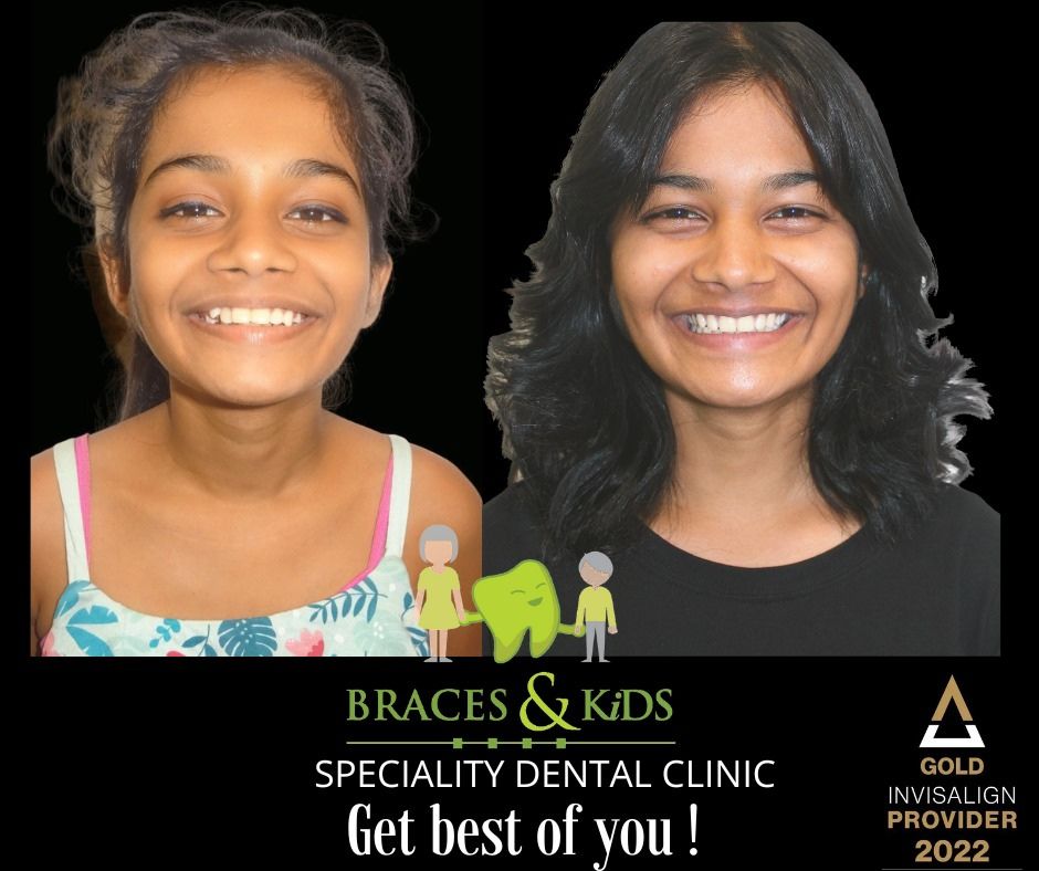 aligners price in mumbai