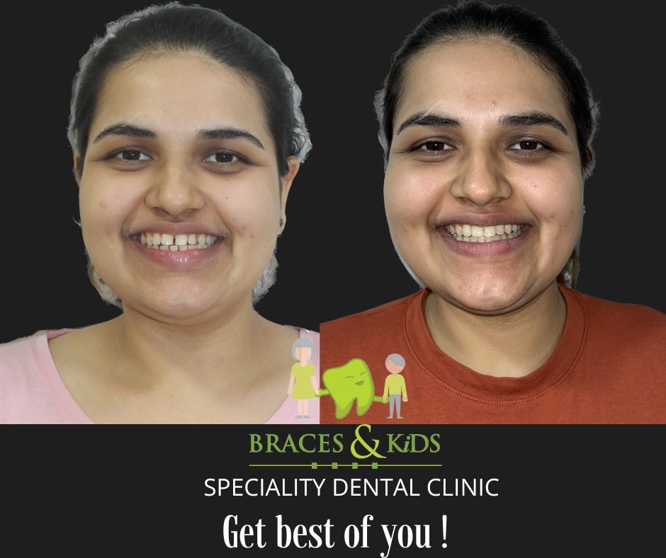 nvisalign clear aligners