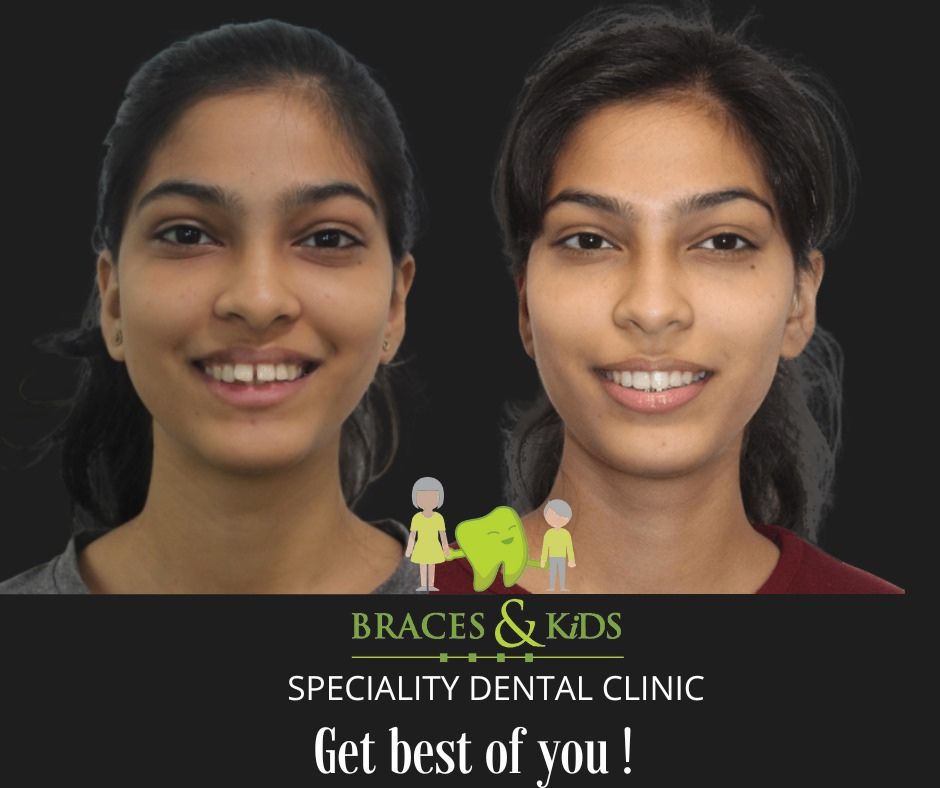 aligners cost in mumbai