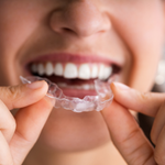 Clear Aligners