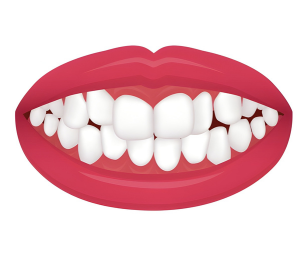 Crooked Teeth