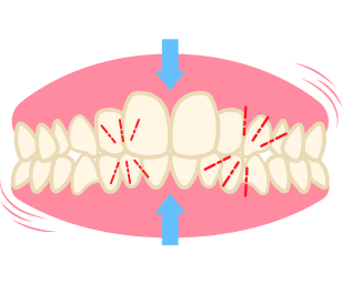 Crowded teeth solution Kandivali