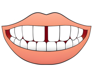 Gaps Between Teeth