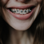 Metal Braces