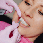 Veneers
