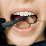 Wisdom Teeth Removal